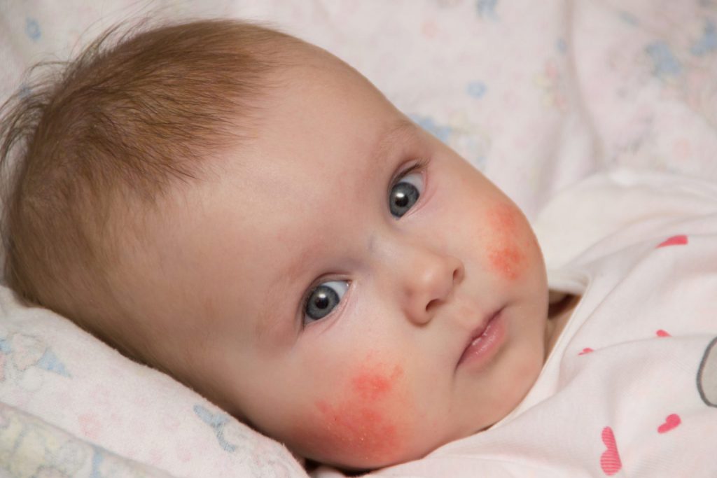 аллергия младенца