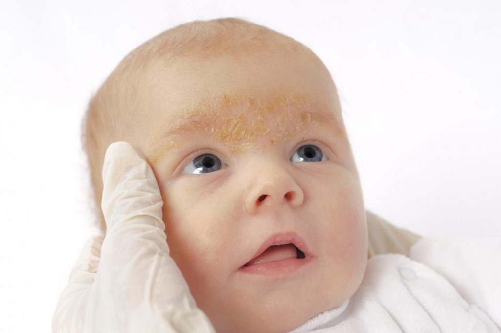 лечение дерматита у ребенка